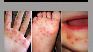 “देहरादून में हैंड-फुट-माउथ डिजीज का प्रकोप, स्कूलों ने एहतियात बरतने को लेकर जारी किया अलर्ट”